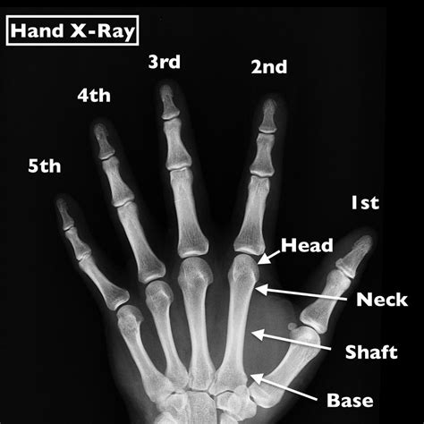 Boxers Fracture 5th Metacarpal Fracture
