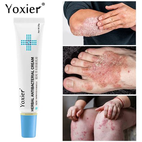 20g Skin External Itching Herbal Antibacterial Cream Psoriasis Cream