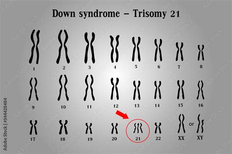 Karyotype Of Down Syndrome Ds Or Dns Also Known As Trisomy Is A