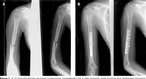 Pdf Treatment Of Nonunion Of Humeral Shaft Fracture With Dynamic Compression Plate And