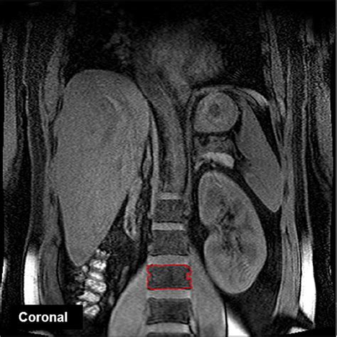 Abdominal Mr Images At Third Lumbar Spine L3 Inside Red Line Level