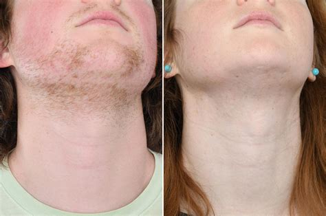 The Ultimate Solution For Pcos Hirsutism Electrolysis Before And After