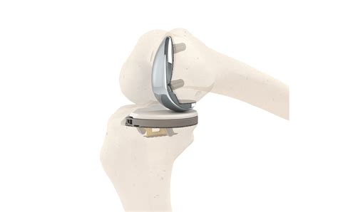 Smithnephew Buys Knee Implant Maker Engage Surgical In 135m Deal