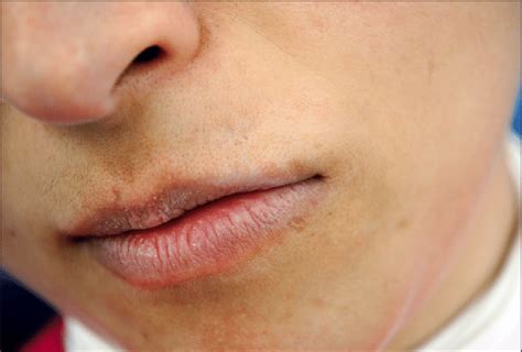 Intermingled White Patches And Erythematous Areas On The Mucosa Of The