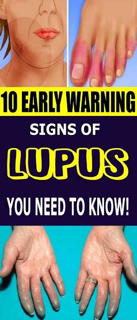 10 Early Warning Signs Of Lupus You Need To Know Wellness Magazine