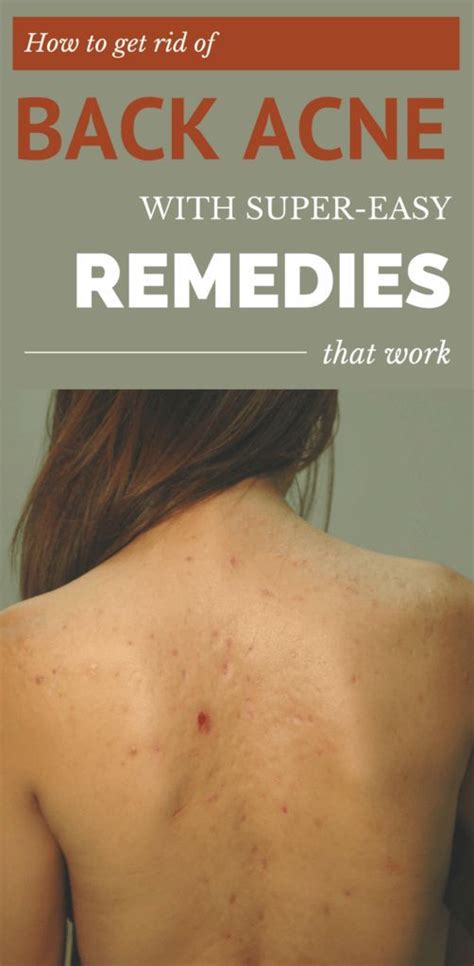 How To Get Rid Of Back Acne With Super Easy Remedies That Work Latest