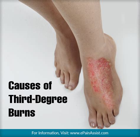 All You Need To Know About Third Degree Burns