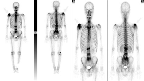 Whole Body Bone Scan With Tc 99m Dpd Shows Increased Radioisotope