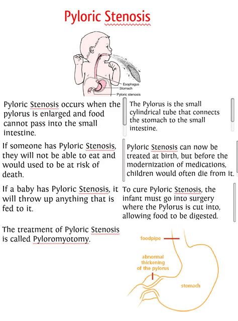 Pyloric Stenosis Publish With Glogster Pediatric Nursing Neonatal