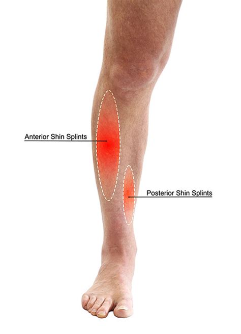Shin Splints What Causes Them And How To Fix Them Petersen Physical