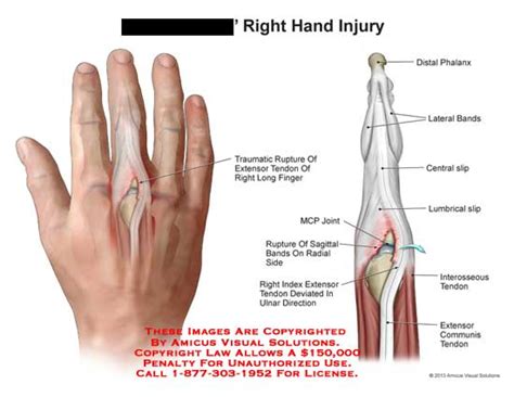 Amicus Illustration Of Amicus Injury Hand Traumatic Rupture Endon