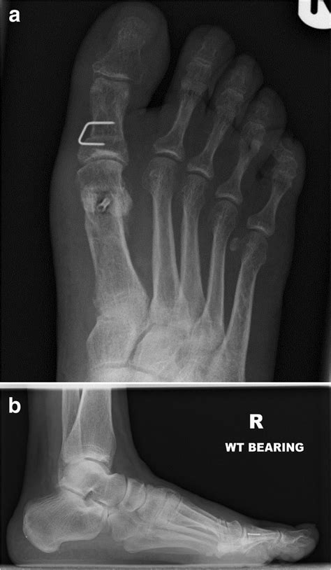 A And B Post Operative Ap And Lateral Radiographs Taken At Six Weeks