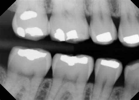 Digital Bitewing X Ray Dr Ari Greenspan Dentist