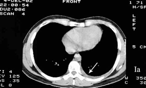 A Ct Scan Showing The Presence Of Pleural Effusion On The Left