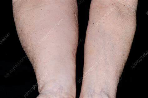 Secondary Lymphoedema In The Arm Stock Image C0130925 Science