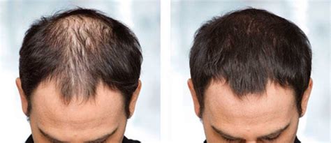 Asymmetrical Male Pattern Baldness Causes And Treatments Justinboey