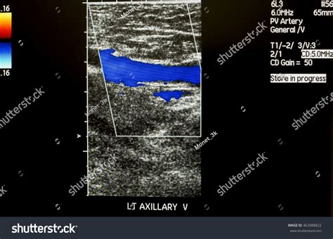 Doppler Ultrasound Left Axillary Vein Stock Photo 463988822 Shutterstock