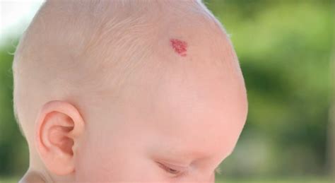 What Causes Birthmarks And Can They Be Treated