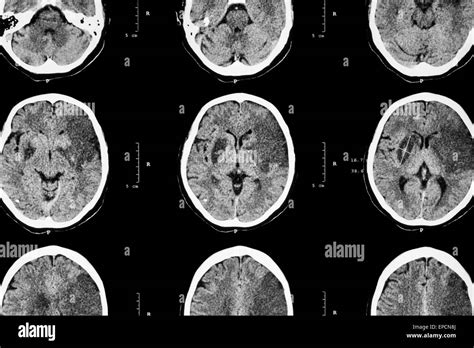 Ischemic Stroke Ct Of Brain Show Cerebral Infarction At Left Stock