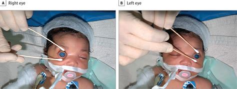 Ophthalmic Manifestations Of Congenital Zika Syndrome Congenital