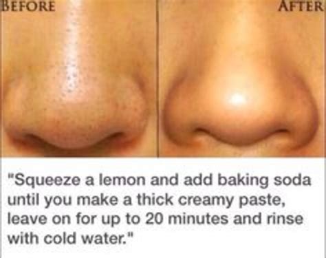 Home Remedies To Reduce Puffy Red Eyes Hubpages