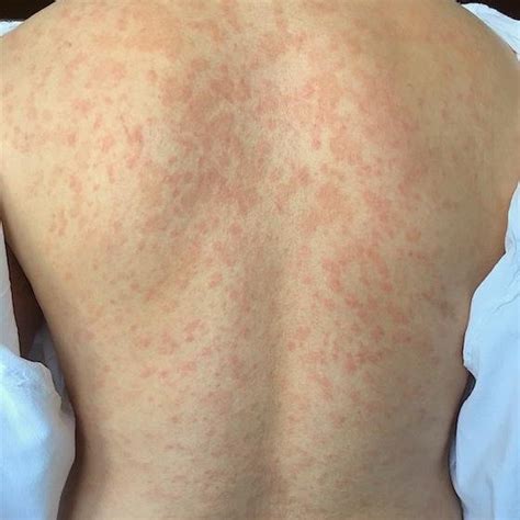 Classical Pityriasis Rosea The Largest Lesion Is The Herald Patch The