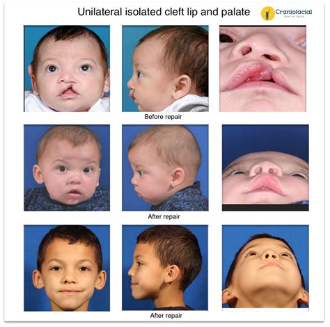 List 102 Pictures Pictures Of A Cleft Palate Completed 10 2023