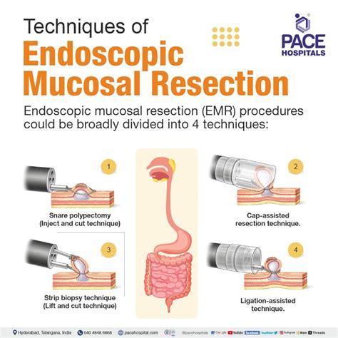 Endoscopic Mucosal Resection In Hyderabad India Indications And Cost