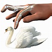 Swan Neck Deformity: Signs, Causes & Treatments - Swan Wonders