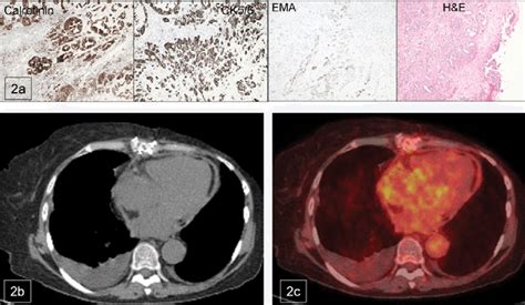 A Pericardial Epithelioid Malignant Mesothelioma Seen On Haematoxylin