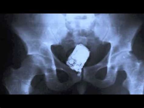 25 Strangest Things Found In An X Ray YouTube