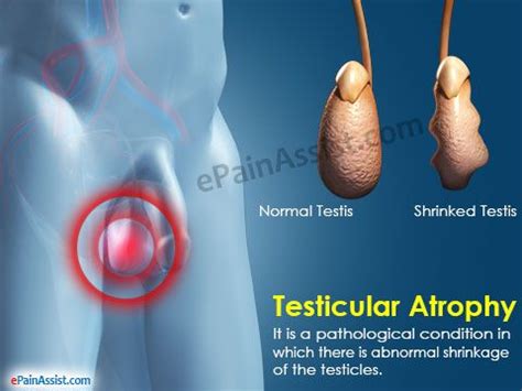 Testicular Atrophy