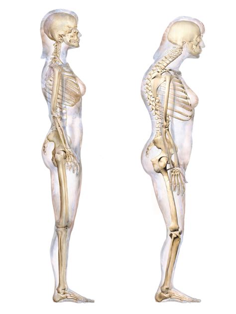 What Is The Difference Between Lordosis Kyphosis And Scoliosis