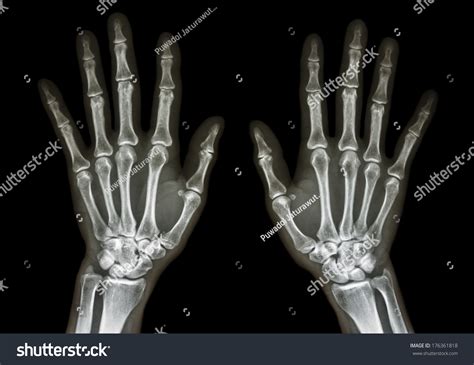 Film X Ray Both Hand Ap Show Normal Humans Hands On Black Background