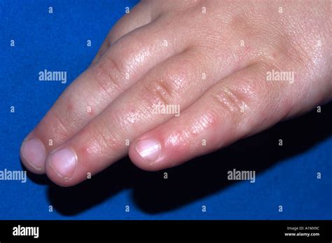 Viral Exanthem From Hand Foot And Mouth Disease Stock Photo 3361435