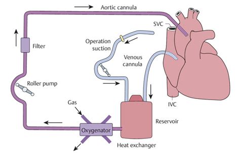 26 Operations With Cardiopulmonary Bypass Thoracic Key