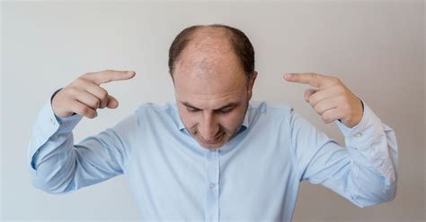 What Are Signs Of Balding At For Men