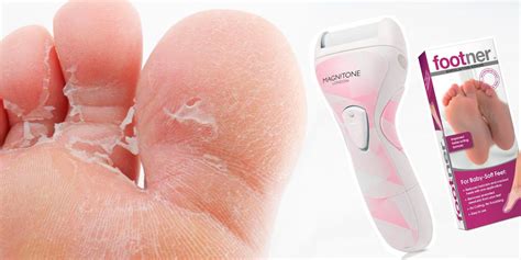 A callus can appear even if there is little to no rubbing. How to get rid of dry skin on feet: 6 gross-but-satisfying ...