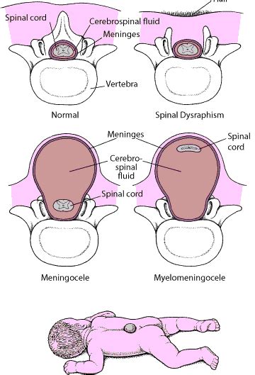 Neural Tube Defects And Spina Bifida Childrens Health Issues Msd