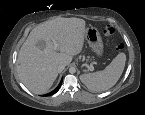 Liver Metastases From Colon Cancer Liver Case Studies Ctisus Ct