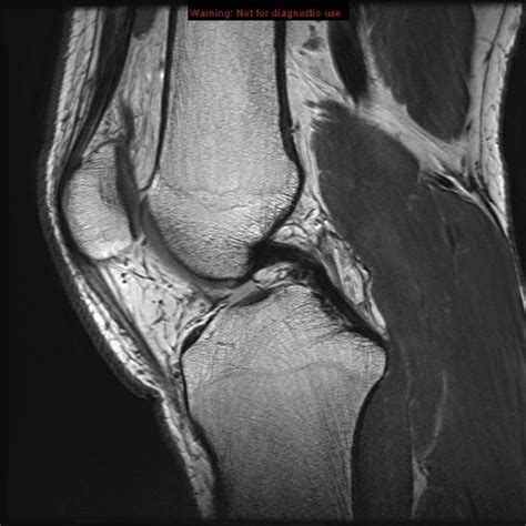 Knee Muscle Anatomy Mri Normal Magnetic Resonance Imaging Anatomy Of