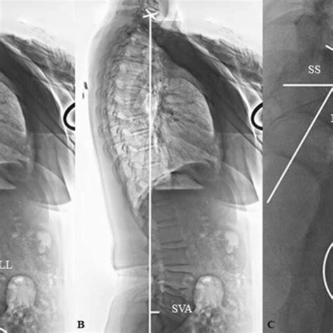 Radiographic Measurements Of Cervical Sagittal Parameters In This