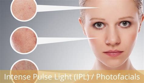 Intense Pulse Light Ipl Photofacials La Bella Vita Medi Spa