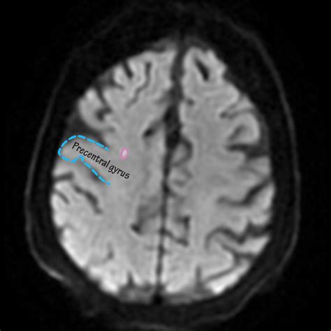Neuroanatomy Glossary Precentral Gyrus Stroke Ditki Medical