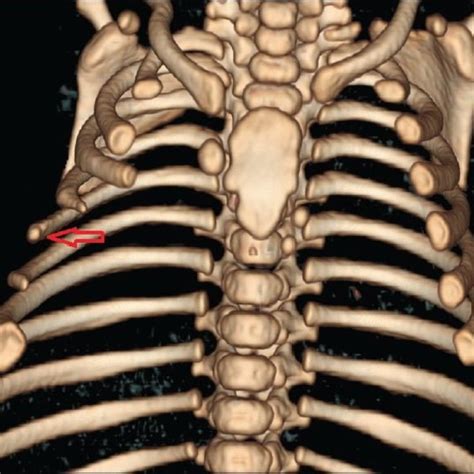 Hypoplastic Right Pectoralis Major Muscle With Reduced Subcutaneous Fat