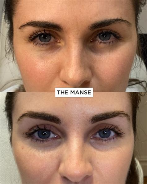 Brow Lift Injections By Our Expert Doctors At Our Sydney Clinic