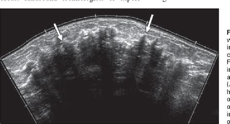 Figure 6—51 From Mri Features Of Inflammatory Breast Cancer Semantic