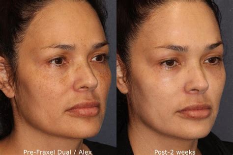 Hispanic Skin San Diego Ca Cosmetic Laser Dermatology