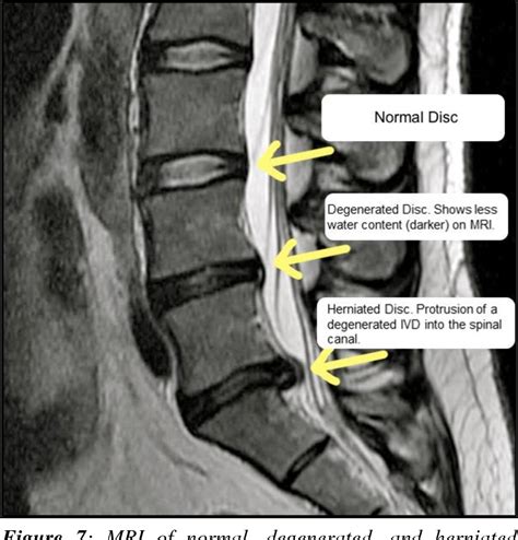 The Development Of A Biomimetic Patch For Annulus Fibrosus Repair