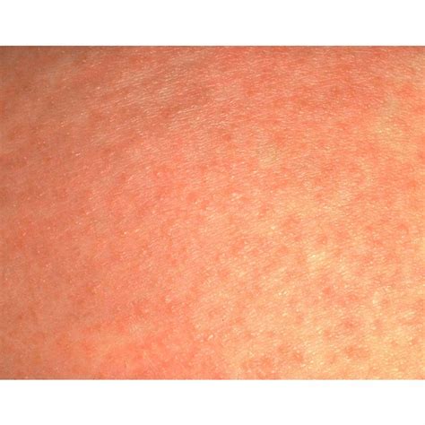Itchy Rash On Torso No Fever Skin Rashes 2019 05 14